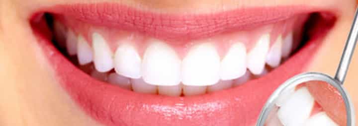 لمینت دندان